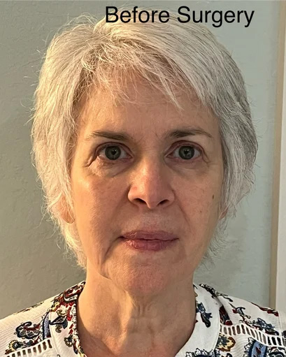 Neck Lift & Facial Fat Transfer Before Surgery