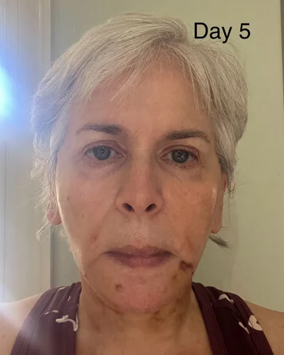 Neck Lift & Facial Fat Transfer Day 5