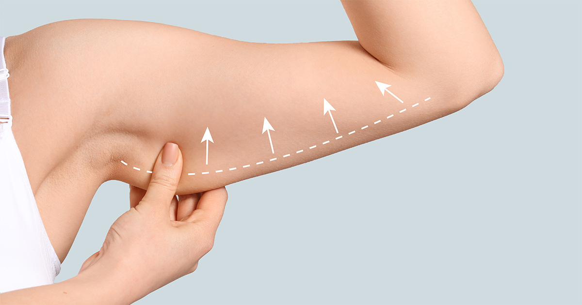 Arm Lift Procedures at Naples Plastic Surgery