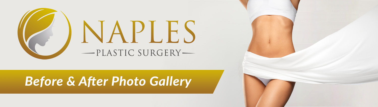 Visit the Naples Plastic Surgery before and after Gallery