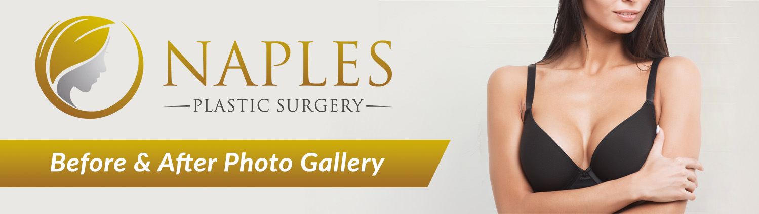 Visit the Naples Plastic Surgery before and after Gallery