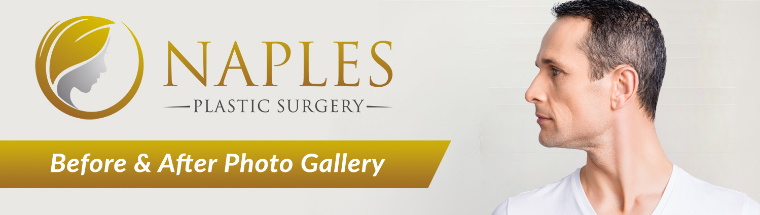 Visit the Naples Plastic Surgery before and after Gallery