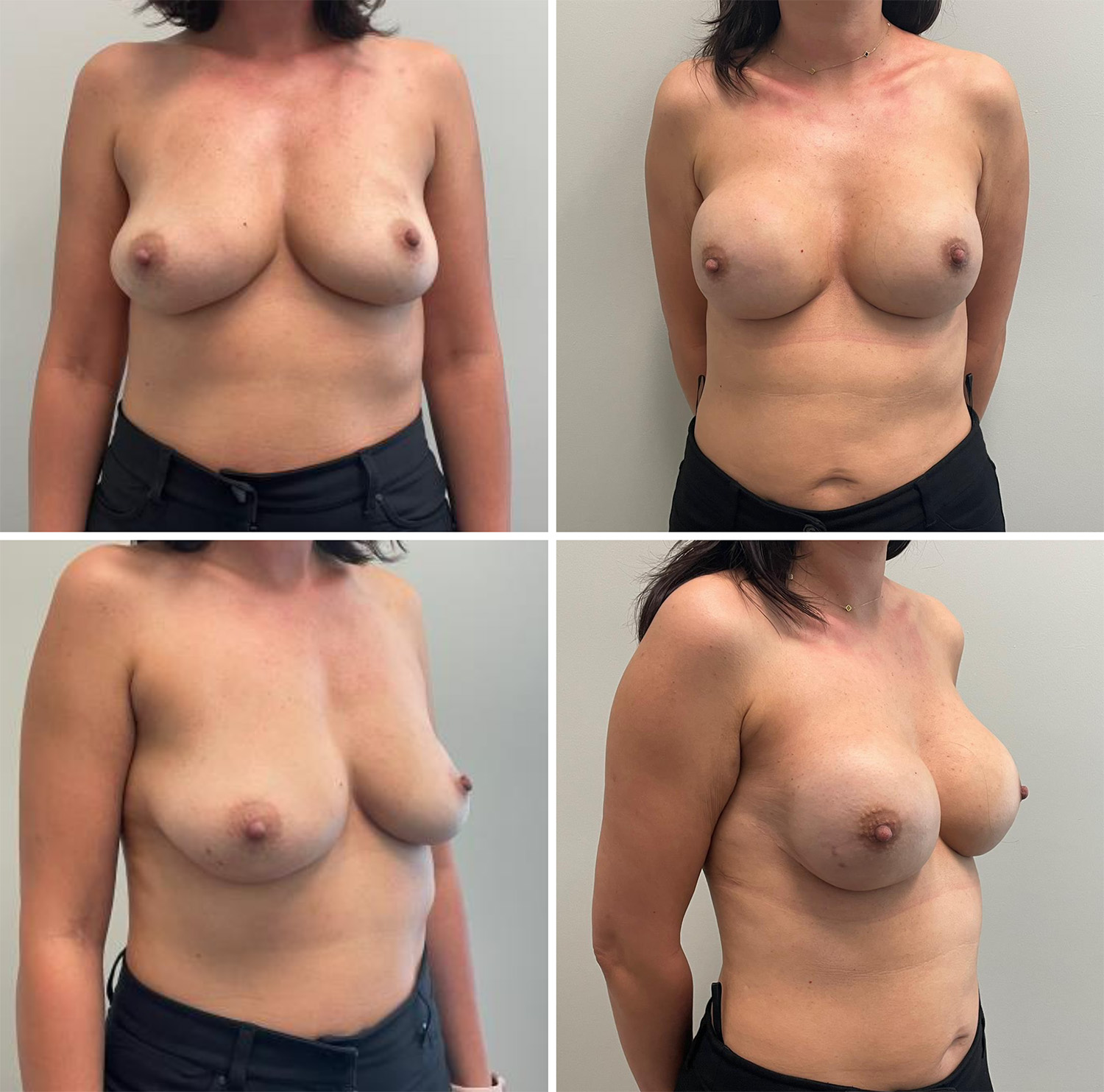 Breast Reconstruction by Dr. Bonett