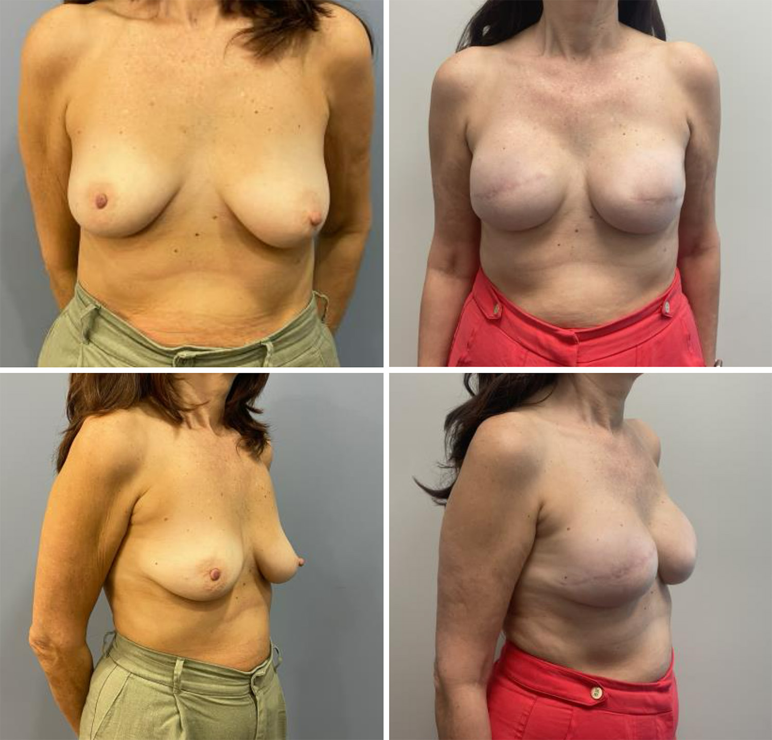 Breast Reconstruction by Dr. Bonett
