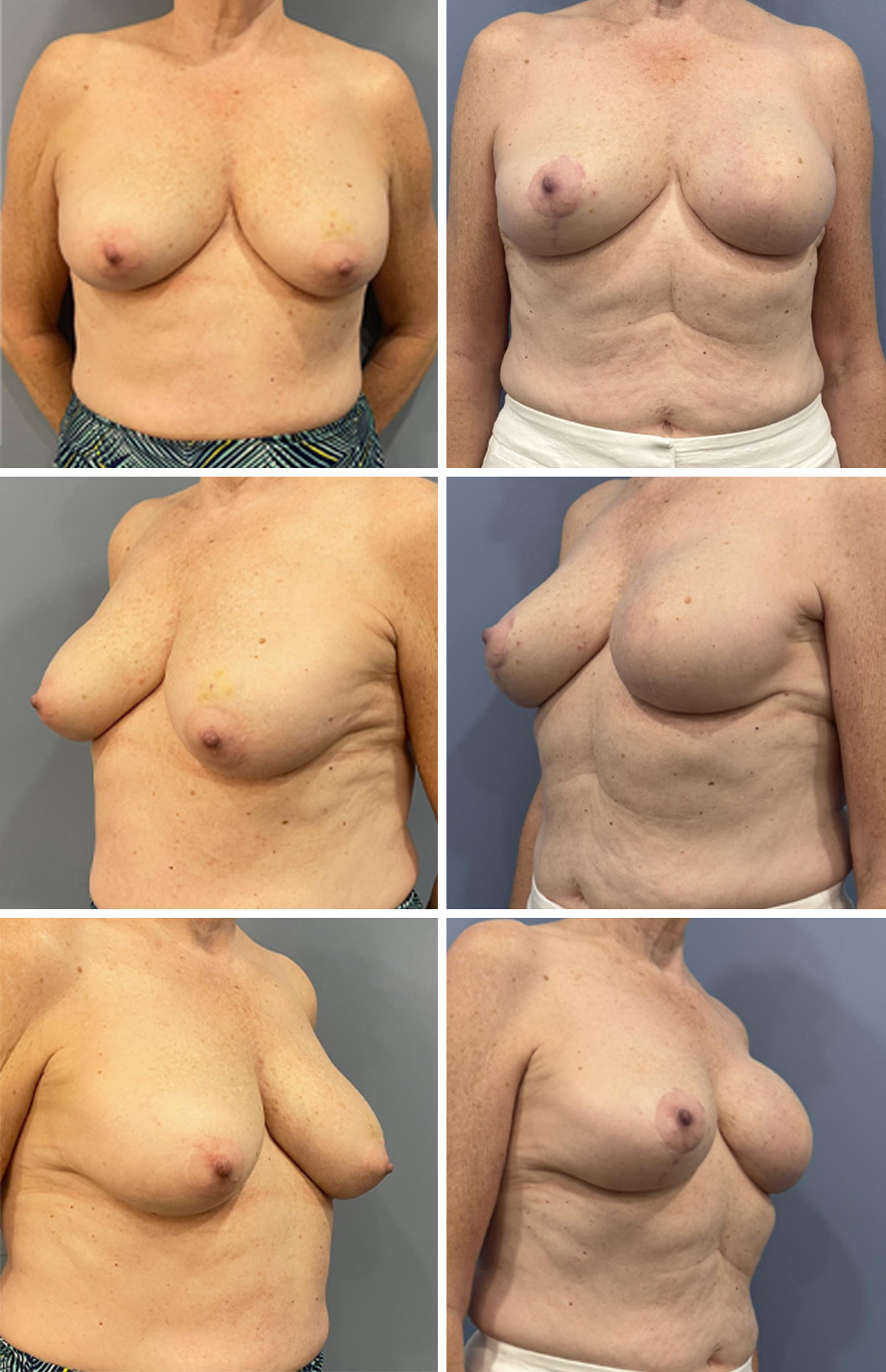 Breast Reconstruction performed by Dr. Bonett
