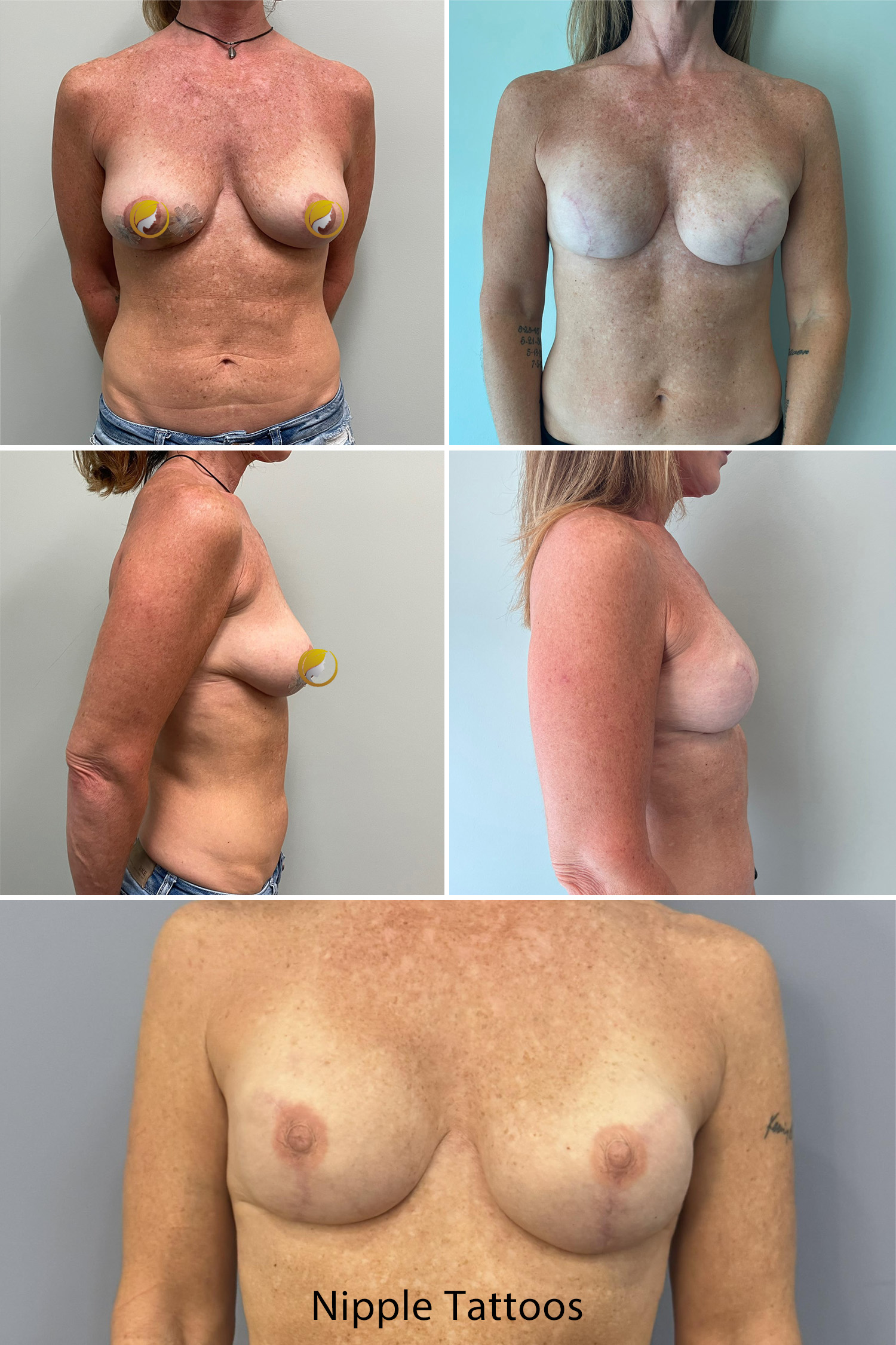 Breast Reconstruction By Dr. Bonett